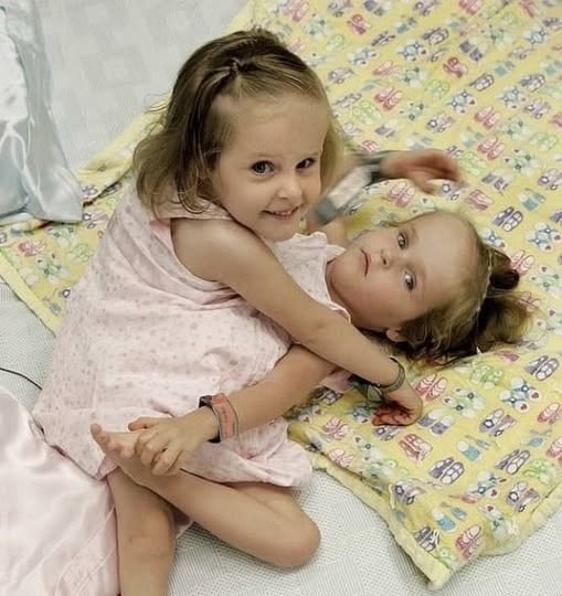 Miracle of Modern Medicine: The Inspiring Journey of Separated Siamese Twins