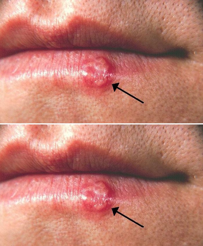 Most People Have Had or Have This Cold Sore Virus, But Very Few Know How to Cure It – Here’s What You Need to Do!