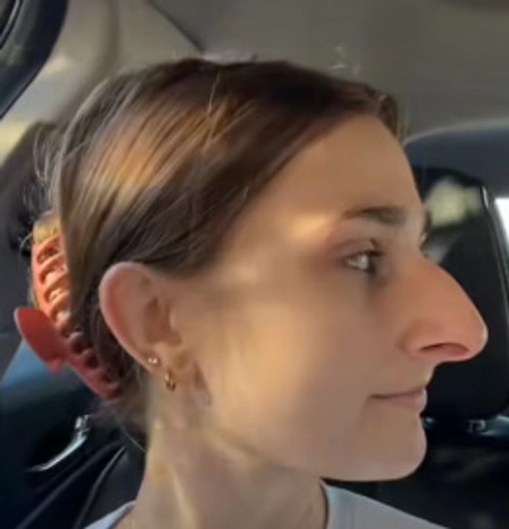 A Stunning Transformation: Woman Shares Her Plastic Surgery Journey