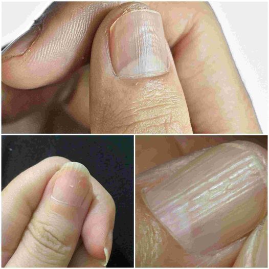 The REAL Causes of Vertical Ridges on Your Nails