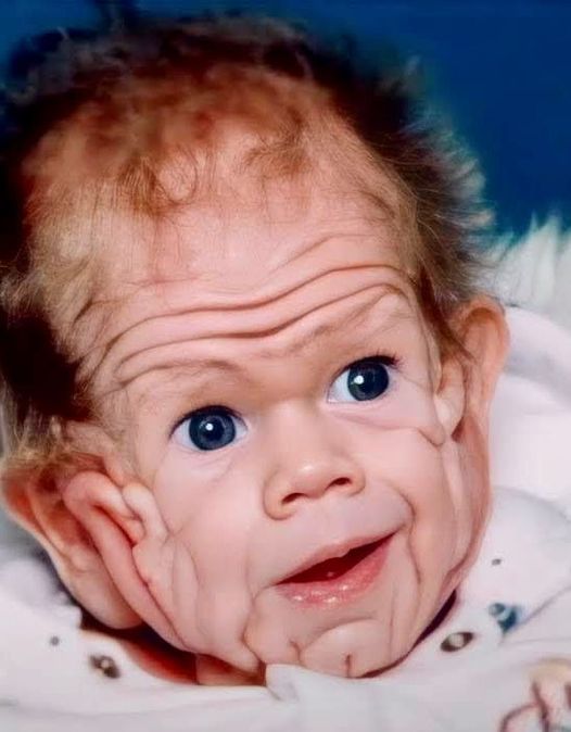 The boy born with a wrinkled body shocked the world…