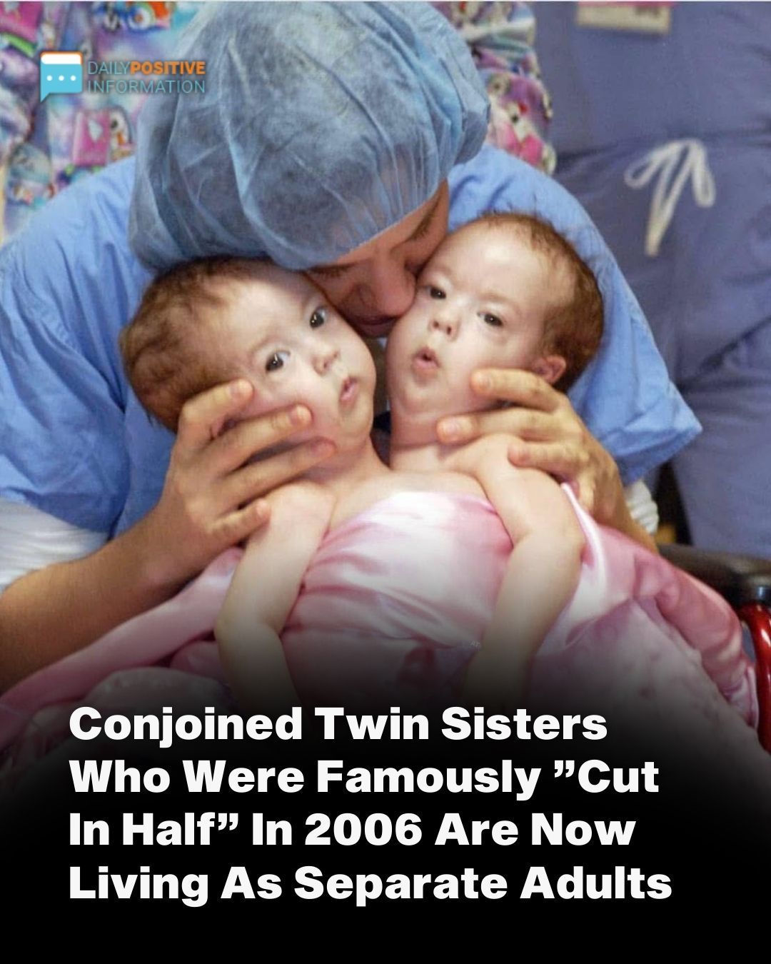 Conjoined Twins Bella And Abby Were Genuinely Associated From Birth, Yet Medical Procedure Changed Everything