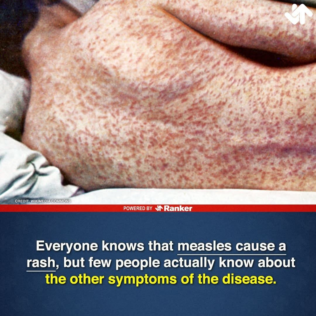 Here’s What Measles Actually Does To Your Body