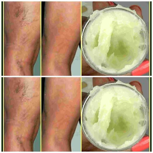 Garlic and Baking Soda for Varicose Veins Relief