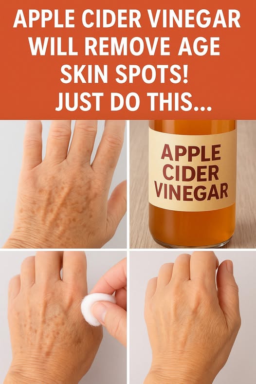 Apple Cider Vinegar for Fading Age Spots Naturally