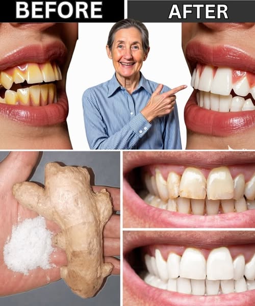 Ginger for Teeth Health and Natural Oral Hygiene Remedies