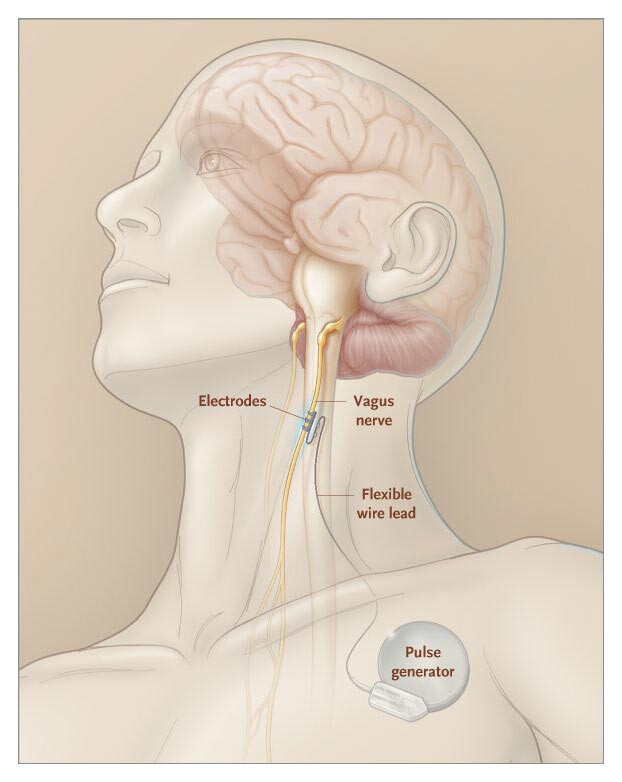 Finding Calm with Vagus Nerve Stimulation Benefits