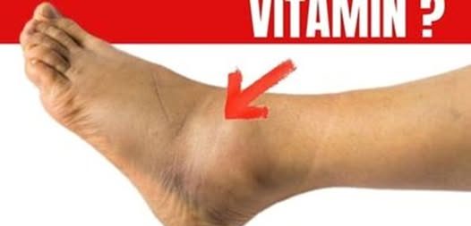 Best Vitamin for Leg & Foot Swelling Relief