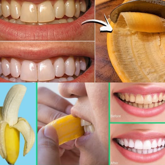 Banana Peel Teeth Whitening: Simple Natural Remedy