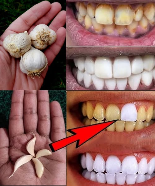 Garlic for Teeth Whitening: A Natural Smile Brightener
