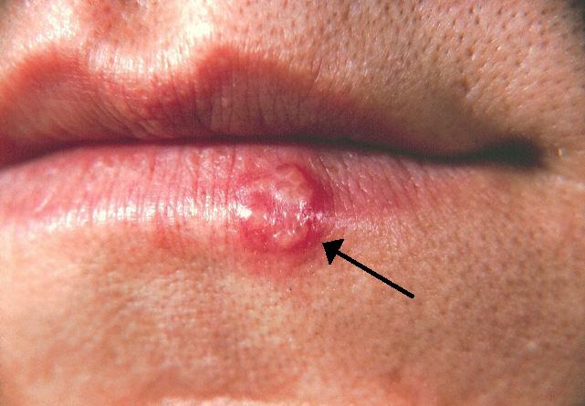 Most People Have Had or Have This Cold Sore Virus, But Very Few Know How to Cure It – Here’s What You Need to Do!
