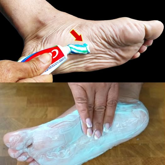 Toothpaste for Healthy Feet: A Simple Home Remedy